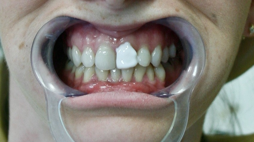 Klej do sklejenia protezy