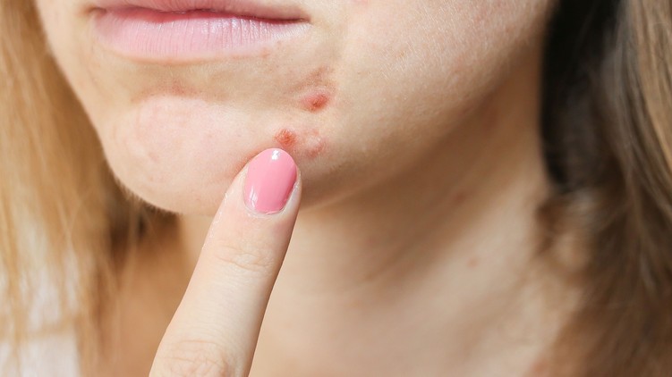 akné, hormonzavar ellen, pattanás oka, bőrprobléma tünete