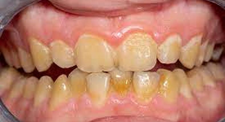 Dents jaunes