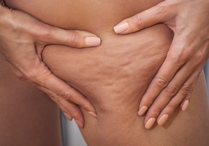 Stručnjaci upozoravaju da je važno razlikovati celulit od lipedema