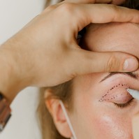 Megereszkedett, lógó szemhéj: ekkor segíthetnek rajta műtéti korrekcióval