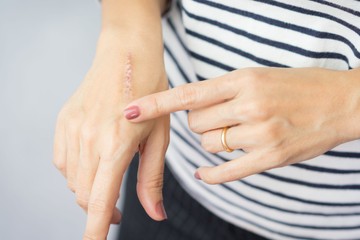Szépészeti beavatkozások után ettől is függ a hegek nagysága