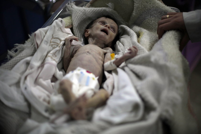 Wstrząsające zdjęcie zagłodzonego niemowlęcia w Syrii obiegło świat