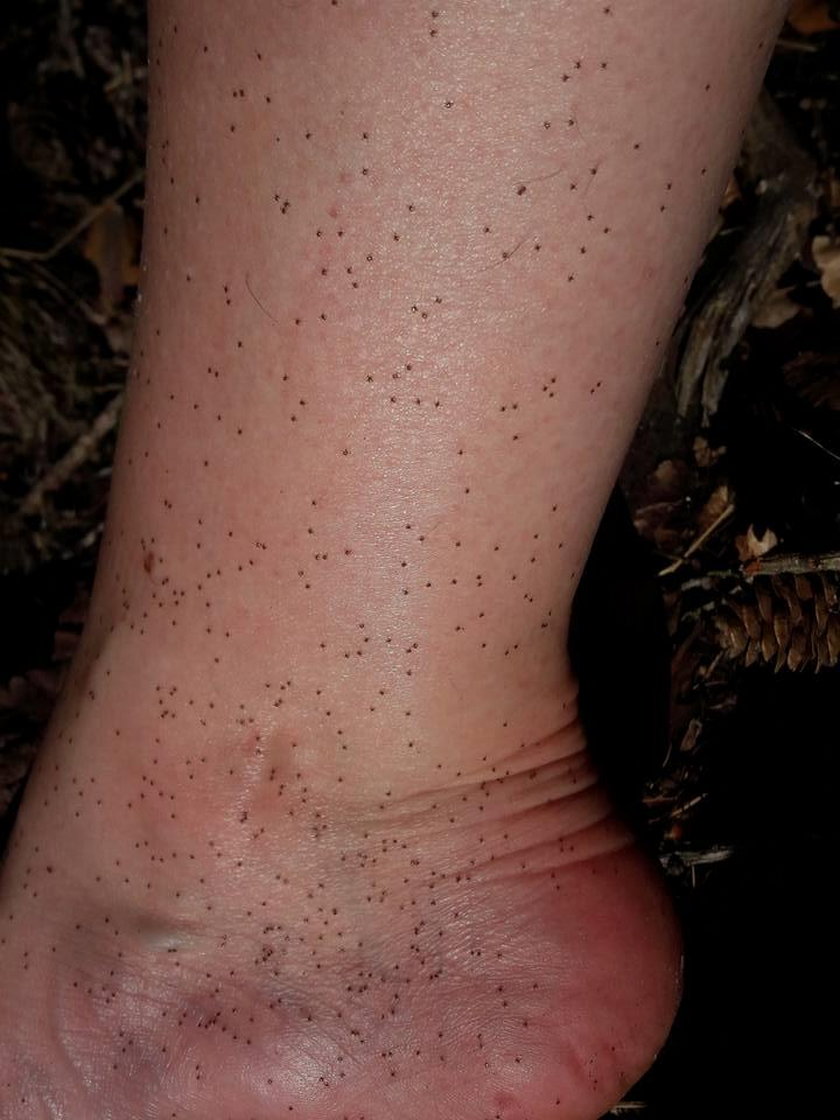 Setki larw kleszczy zaatakowały nogę pani Jowity