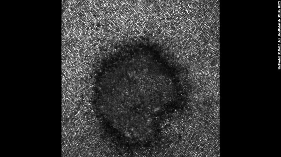 Oštećenje mrežnjače u obliku polumeseca