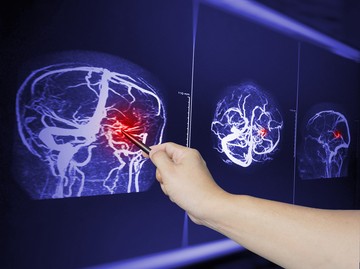 Mit jelent az agyi ödéma? Ezek az agyödéma okai, tünetei és kezelési lehetsőségei