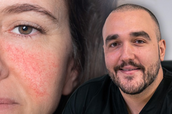 Stop kapilarima oko nosa, na obrazima i bradi: Savremeni tretmani koji dubinski obnavljaju kožu i vraćaju joj miran izgled