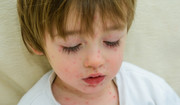 Ospa wietrzna i półpasiec u dziecka - jak odróżnić te choroby zakaźne od siebie?