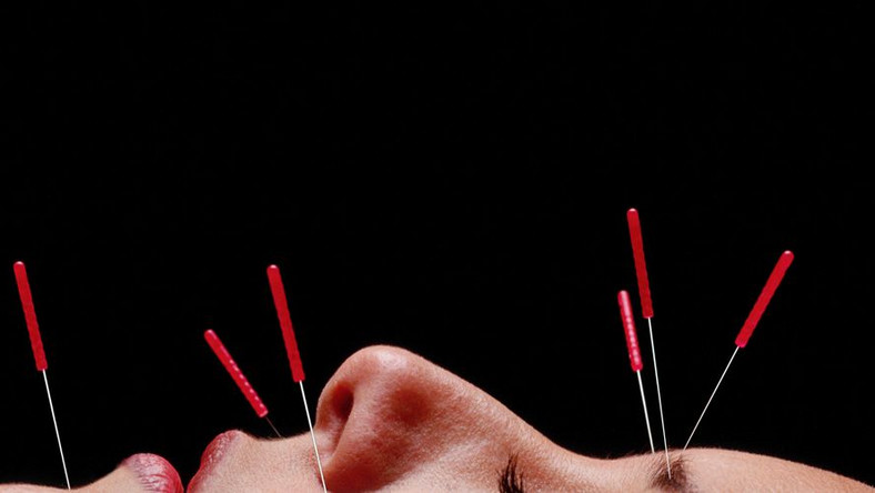 Can Acupuncture Really Help You Lose Weight?