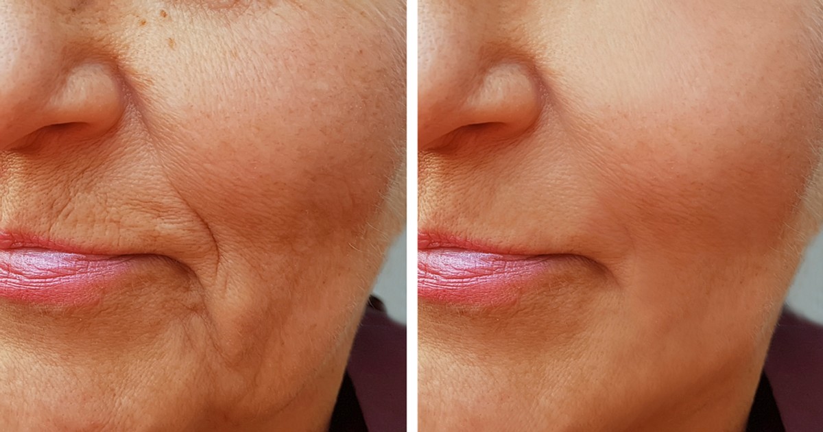 11 powodów, żeby stosować kwas hialuronowy. Po pierwsze - zmniejsza ...
