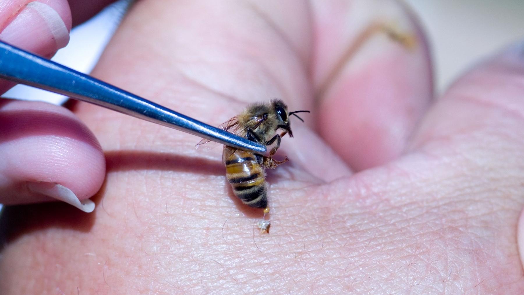 Uštipla vás včela, osa či sršeň? Kedy je to nebezpečné, napovie aj tento 1 príznak: Čo robiť, plus čo všetko treba vedieť o alergii na včelí jed z pohľadu odborníkov