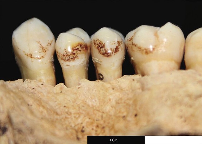 Žućkasto-braonkasta boja na zubima zbog upotrebe duvana ostaje vekovima na zubima nakon smrti