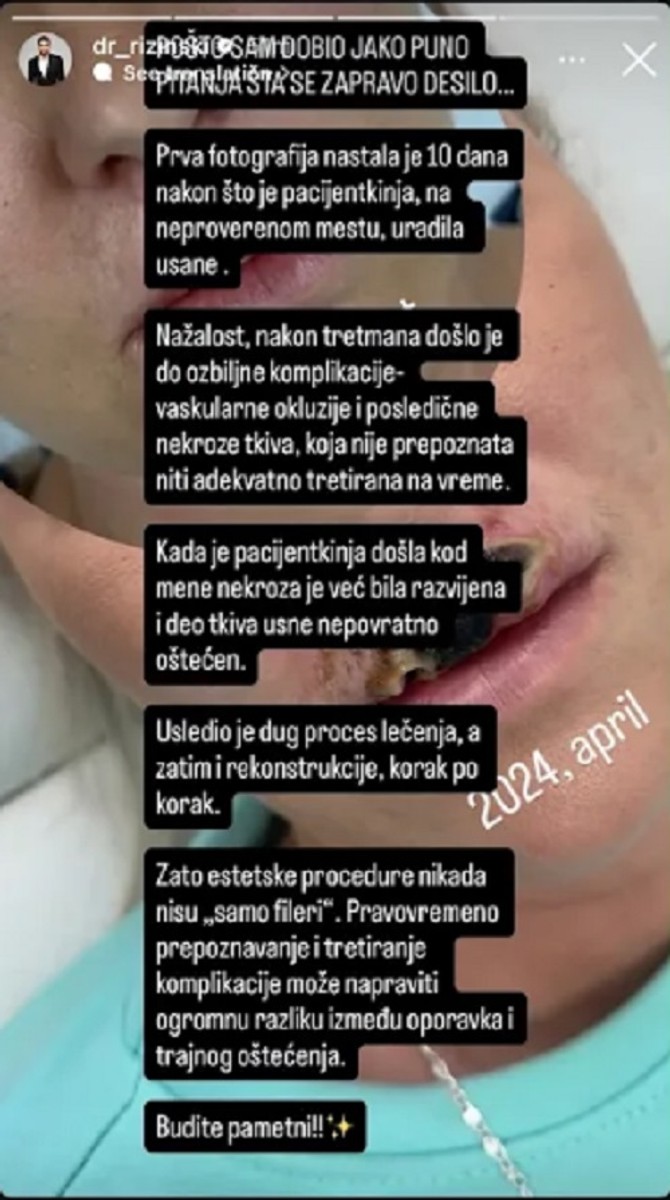 Korekcija usana izazvala stravične posledice