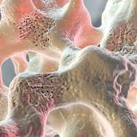 Mi az osteoporosis? Ezek a csontritkulás okai, tünetei és kezelési lehetőségei
