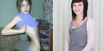 One pokonały anoreksję! Wyjątkowe zdjęcia