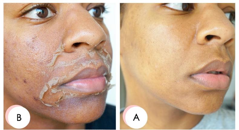 An example of a chemical peel [Healthglow]