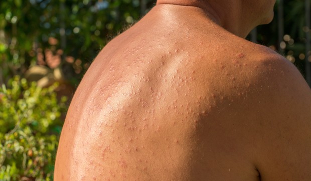 Najčešća alergijska reakcija kože na kremu za sunce je osip.