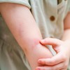 Za trudnice i dojilje koje imaju hereditarni angioedem nedostaje profilaktička terapija 
