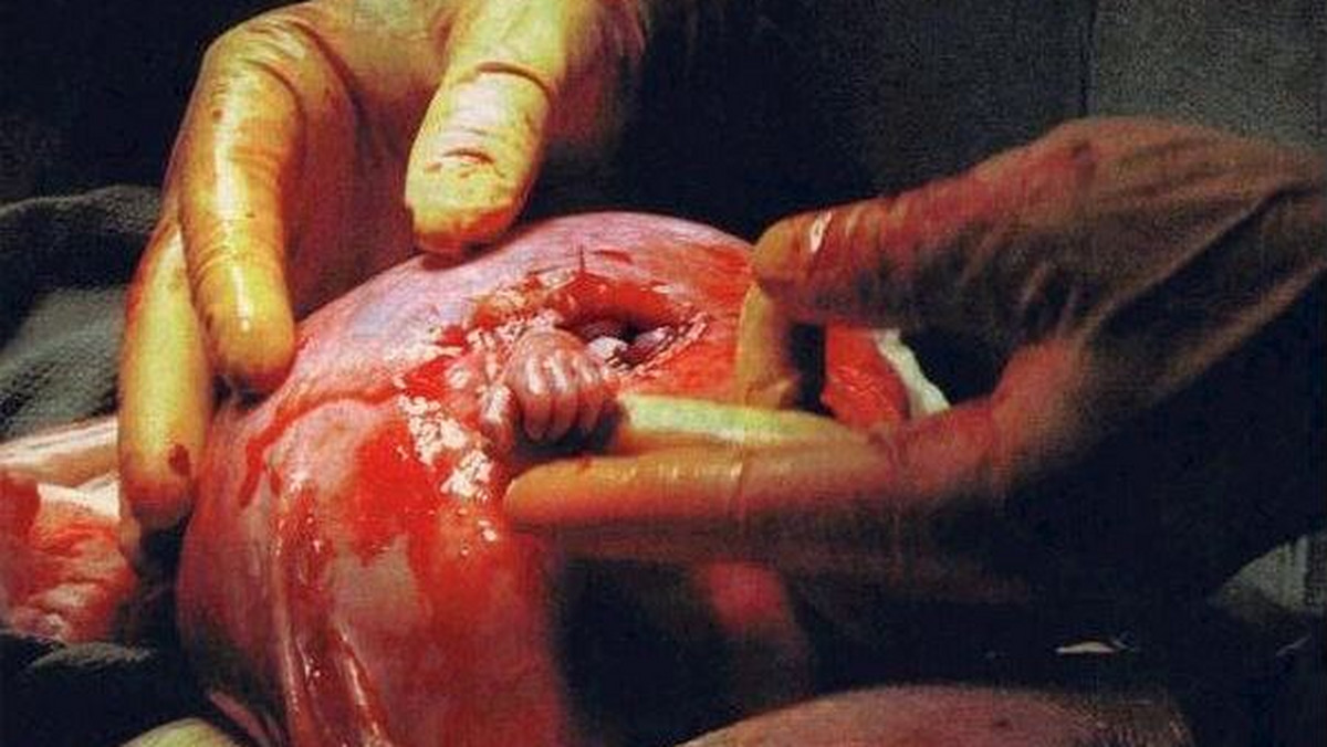 19 sierpnia 1999 roku lekarze z Nashville w Stanach Zjednoczonych zdecydowali się na operację 21-tygodniowego dziecka, które znajdowało się jeszcze w łonie matki. Podczas zabiegu wykonano niezwykłe zdjęcie, które stało się symbolem nadziei dla wielu ludzi na całym świecie.