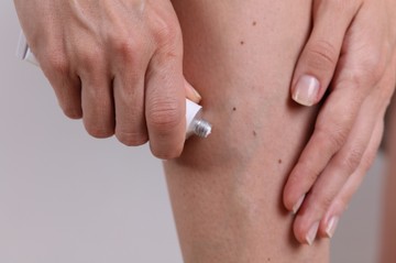 Rossz hír a visszérkrémekről: csak ezeken a problémákon segíthetnek