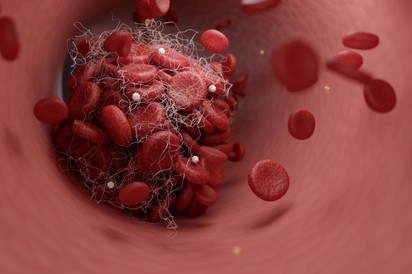 A vérben lévő mikroműanyagok akár el is zárhatják az ereket és stroke-ot okozhatnak