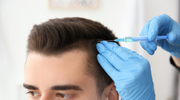 Przeszczepianie włosów - co warto wiedzieć o zabiegu? Cena przeszczepu włosów