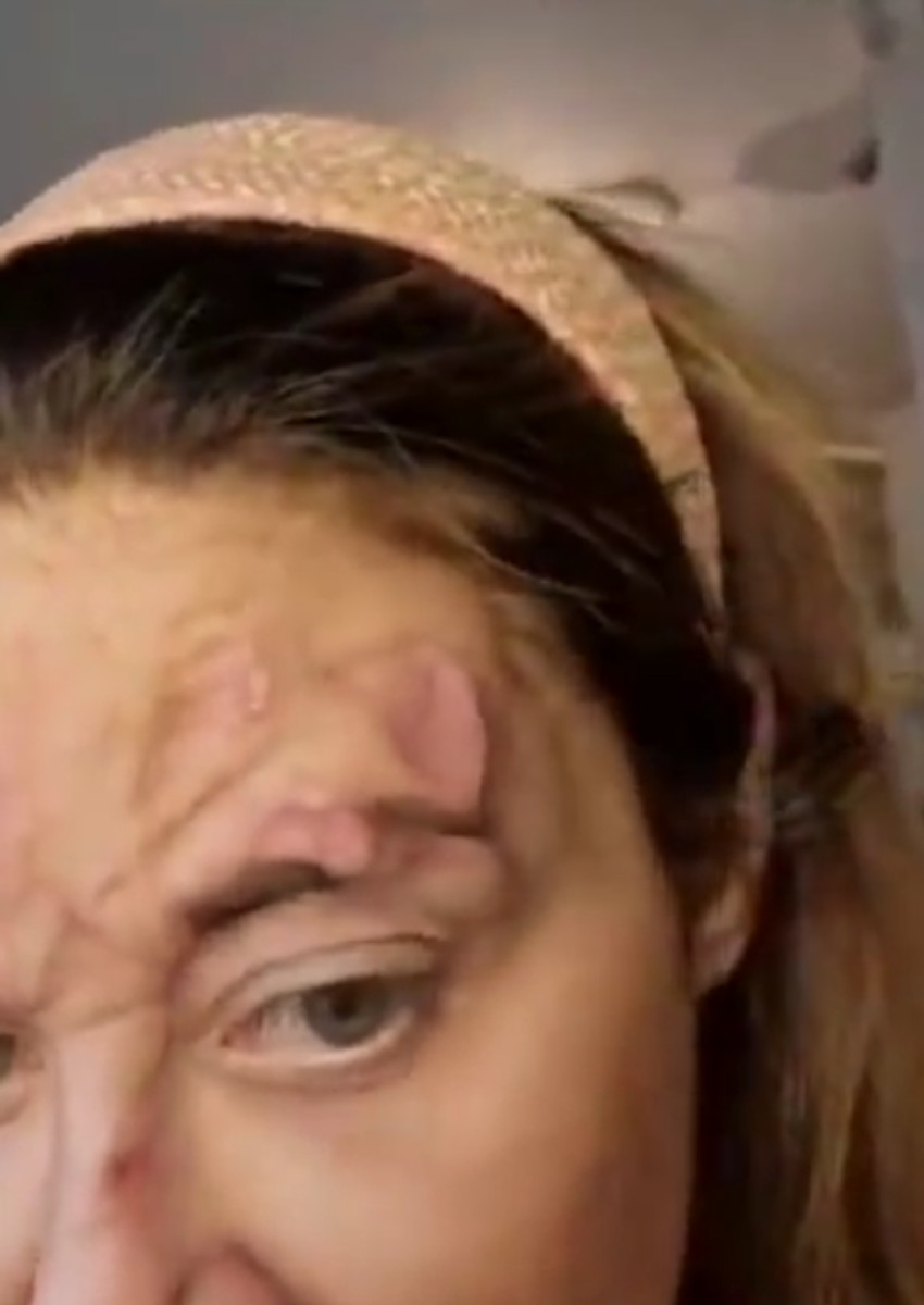 Ana Nikolić sa kožnim problemima