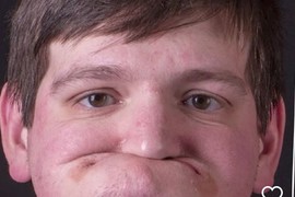 STOMATOLOG IZVEO ČUDO! Pacijent BEZ ZUBA sa 'zgužvanim licem' sad izgleda KAO MANEKEN: Ugradio je implante i osmehom OBARA S NOGU