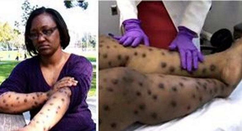 Woman turns into 'leopard' after trying to bleach her skin