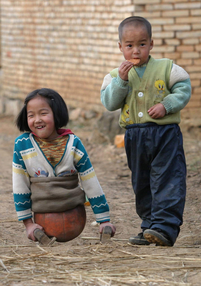 Dziadek dziewczynki wykorzystał piłkę do koszykówki, aby zrobić jej specjalny ochraniacz na miednicę. Dzięki temu pomysłowi Qian mogła bawić się z innymi dziećmi