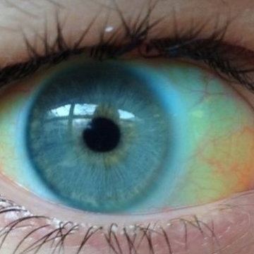 Jakie choroby zdradzają oczy. Co można wyczytać z oczu