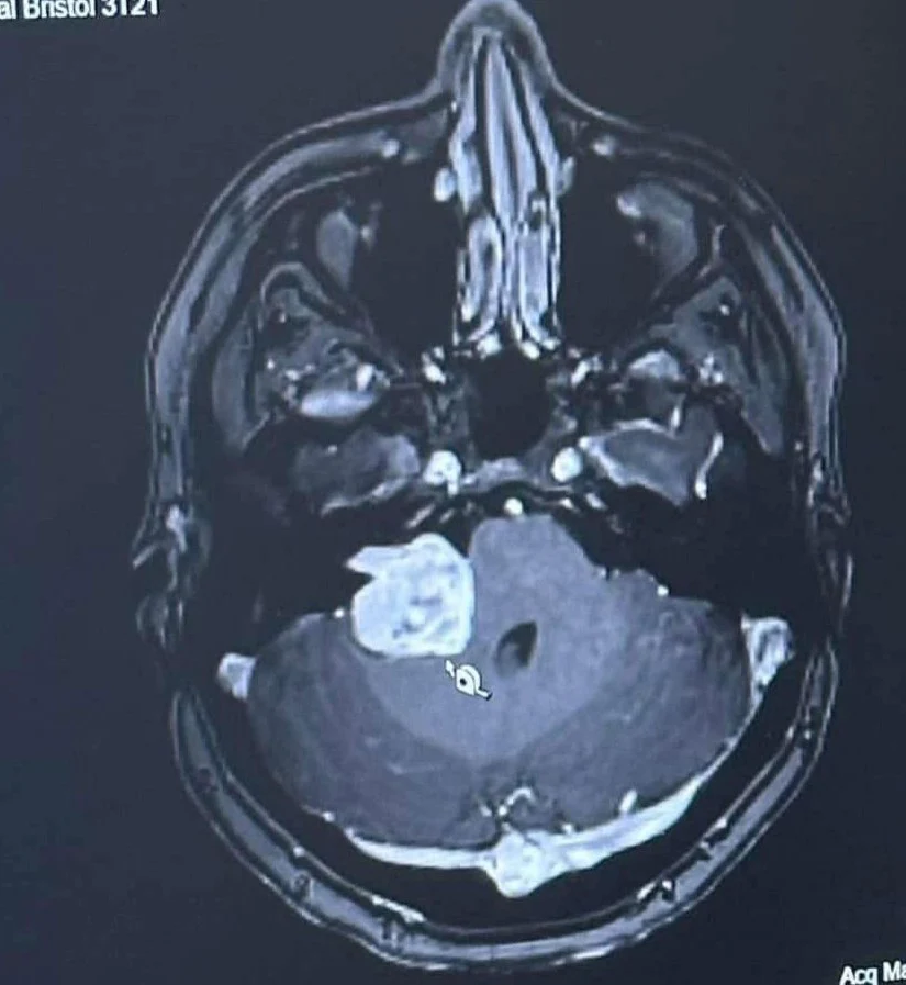 Amy diagnostikovali nádor na mozgu.