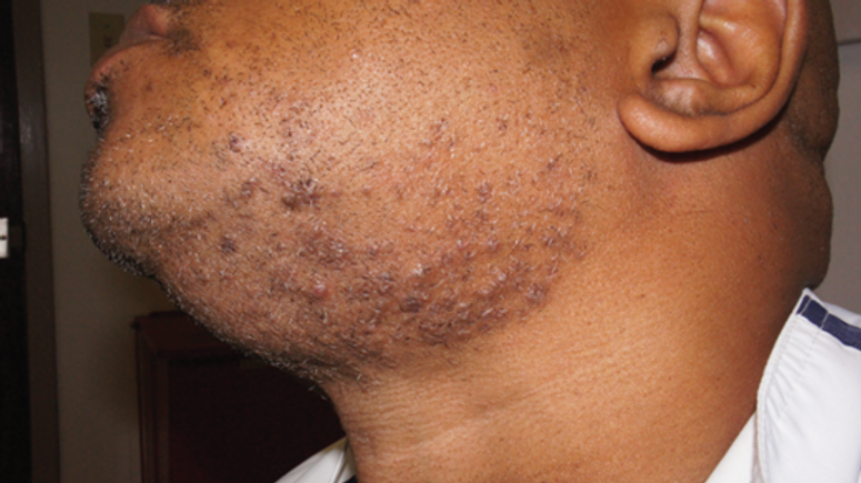 5 Fast Ways To Treat Razor Bumps At Home Pulse Nigeria