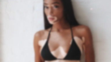 Winnie Harlow nowym aniołkiem Victoria's Secret