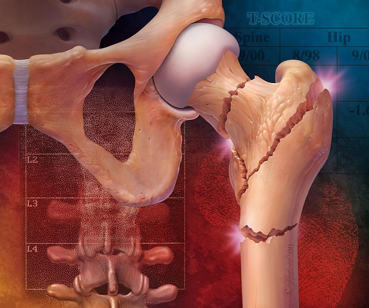 Osteoporoza a złamania