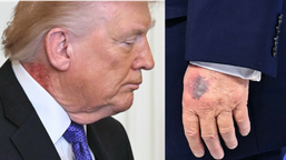 coś się dzieje ze zdrowiem donalda trumpa. nowe duże, czerwone plamy. lekarz tłumaczy