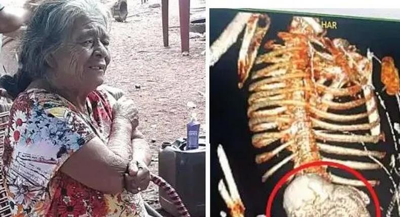 Woman carries dead foetus for 56 years, dies after removal surgery
