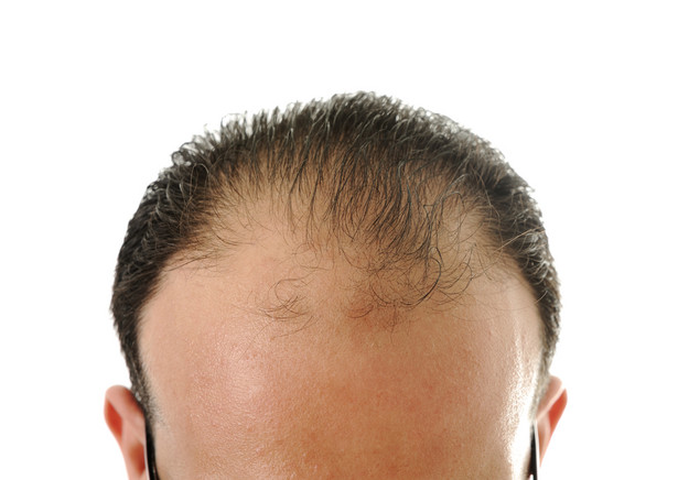 Co powoduje męskie łysienie?