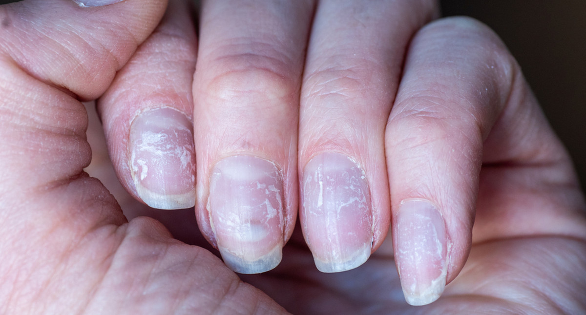 Jak uratować paznokcie po hybrydzie? Domowe sposoby na regenerację i  wzmocnienie