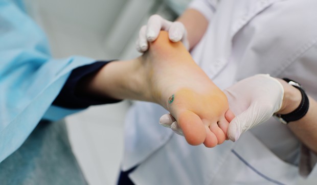 Melanom na stopalu obično se pojavljuje na tabanu ili ispod nokta na nozi