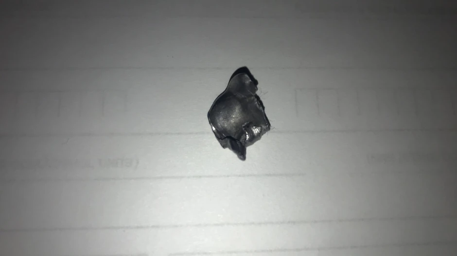 Metak koji je izvađen iz ruke mladića