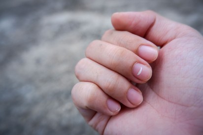 Kalciumhiány: ilyen erősen függ a kialakulása a D-vitamintól