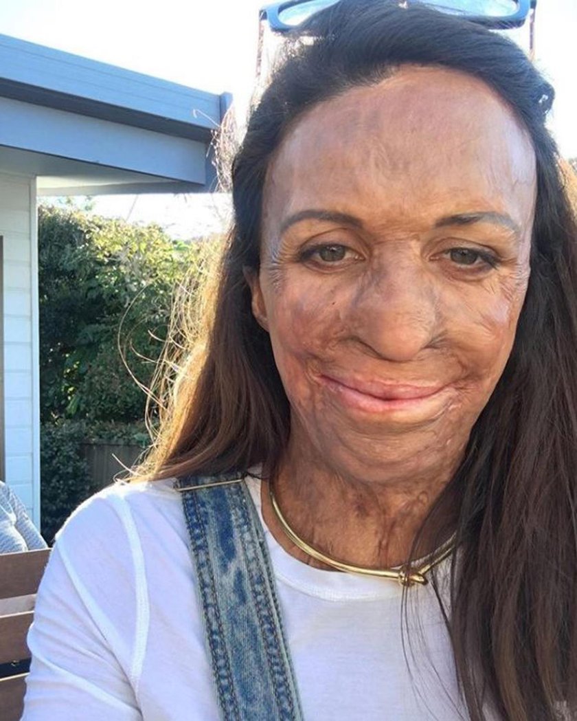 Modelka Turia Pitt omal nie spłonęła żywcem. Teraz została mamą