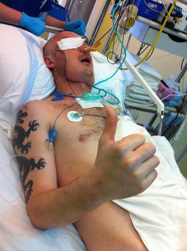 Pierwszy w Polsce przeszczep twarzy