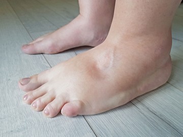 Ödéma - ezzel az egyszerű módszerrel megtudhatja, milyen stádiumban van