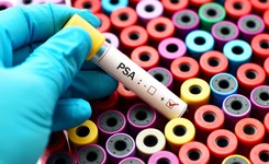 Eksperci: Pacjenci coraz częściej zgłaszają się z bardziej zaawansowanymi nowotworami