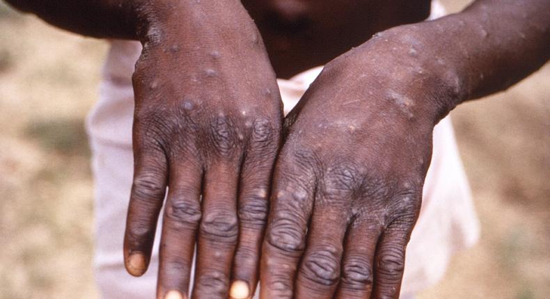 A person with monkeypox in the Democratic Republic of the Congo holds out their hands, which are covered in lesions.