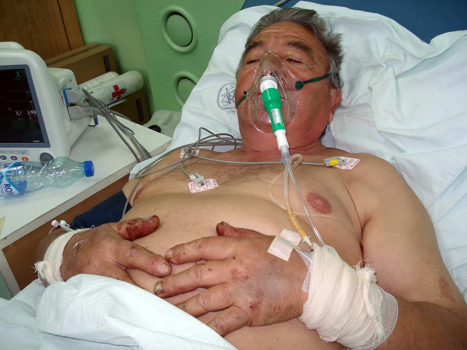 Jedna noga mu je amputirana, a lekari se bore da spasu drugu