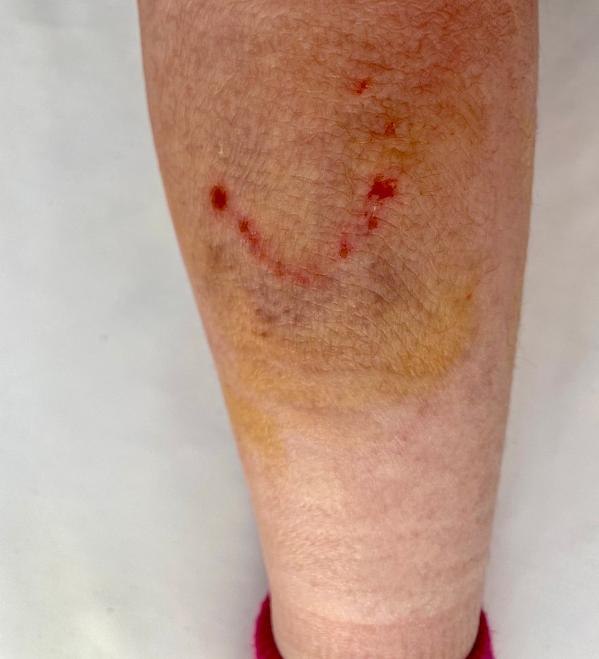 Noga devojcice koju je ujeo pas