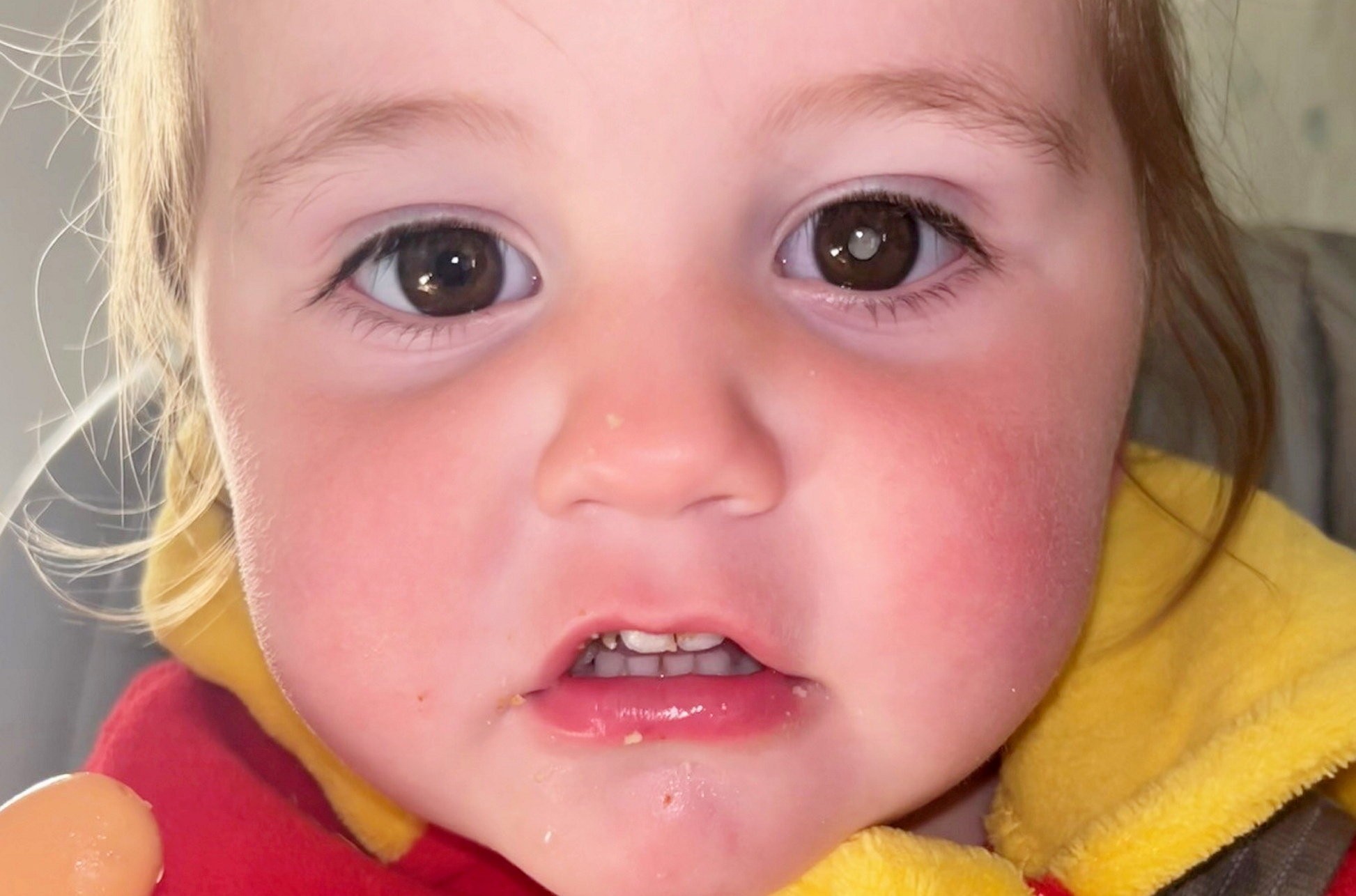 Dievčatku diagnostikovali retinoblastóm v pokročilom štádiu.
